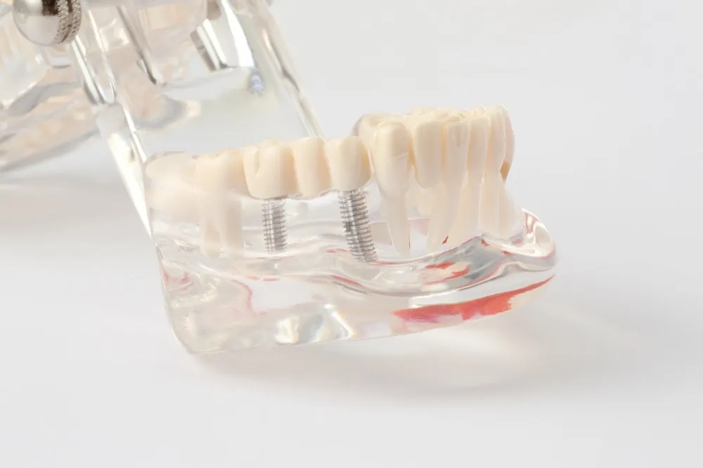 インプラント治療